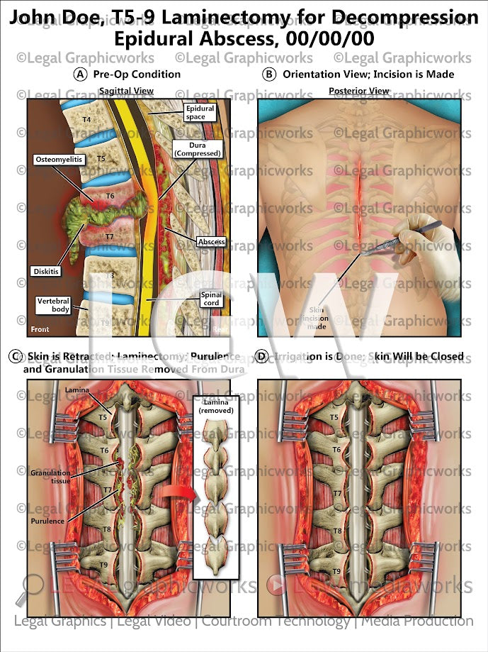 T5-9 Laminectomy for Decompression Epidural Abscess