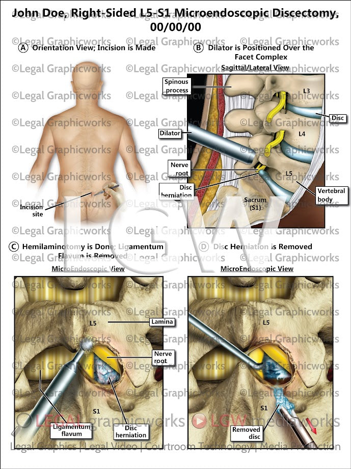 Right-Sided L5-S1 Microendoscopic Discectomy