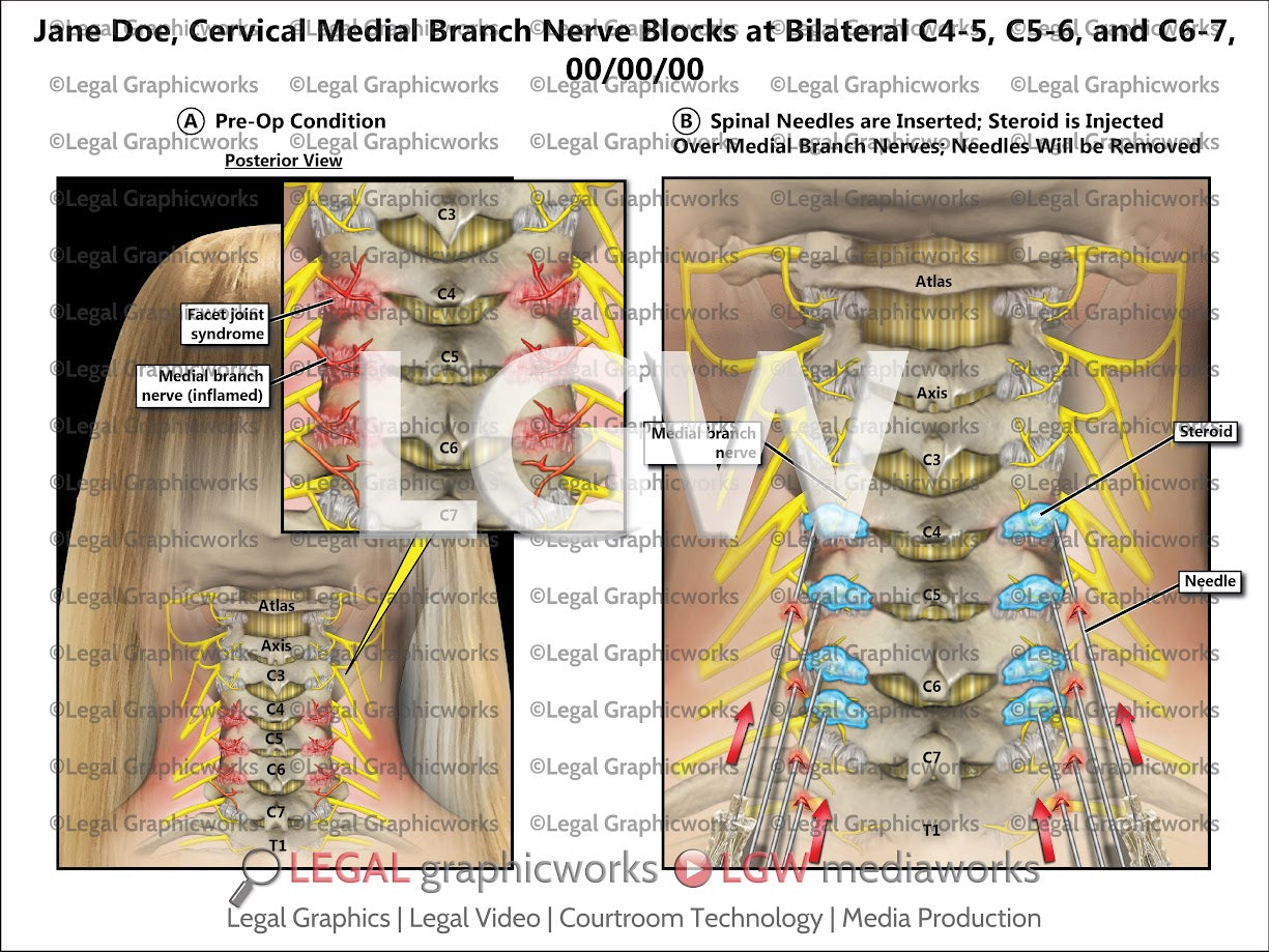 Cervical Medial Branch Nerve Blocks at Bilateral C4-5, C5-6, and C6-7