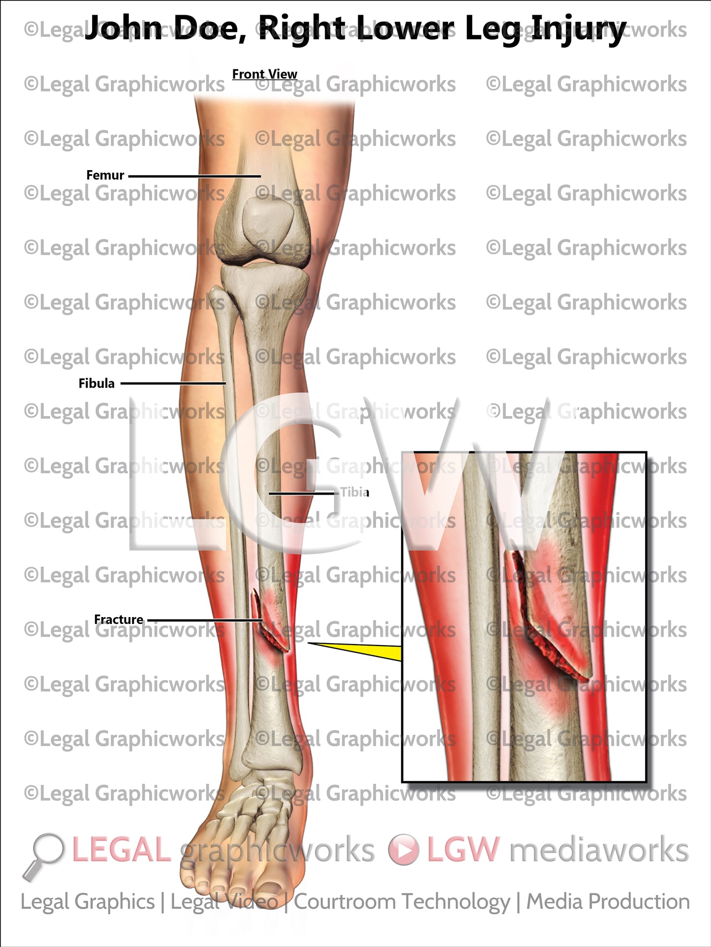Right Lower Leg Injury