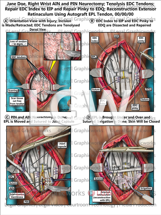 Right Wrist AIN and PIN Neurectomy; Tenolysis EDC Tendons; Repair EDC Index to EIP and Repair Pinky to EDQ; Reconstruction Extensor Retinaculum Using Autograft EPL Tendon