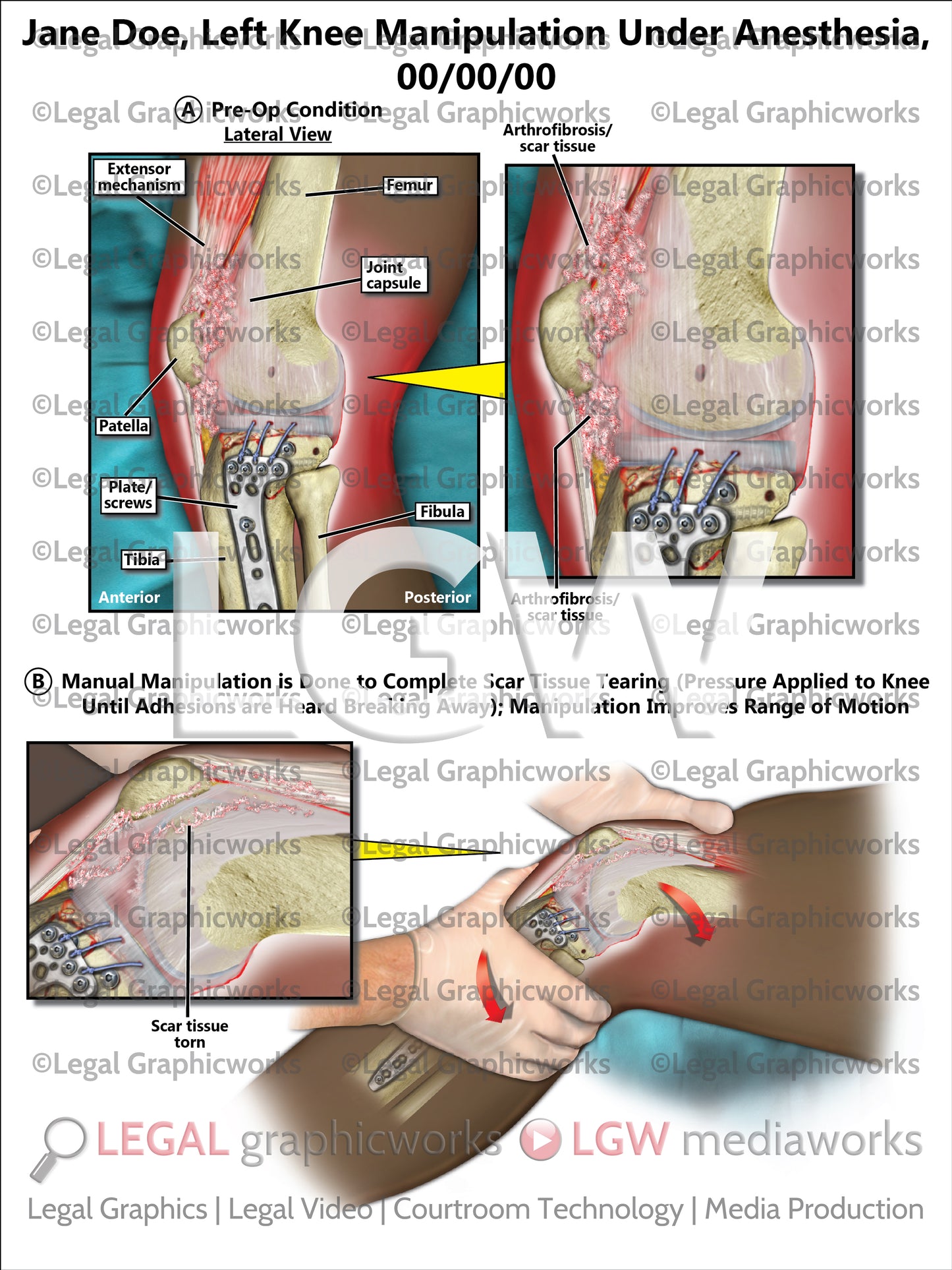 Left Knee Manipulation Under Anesthesia