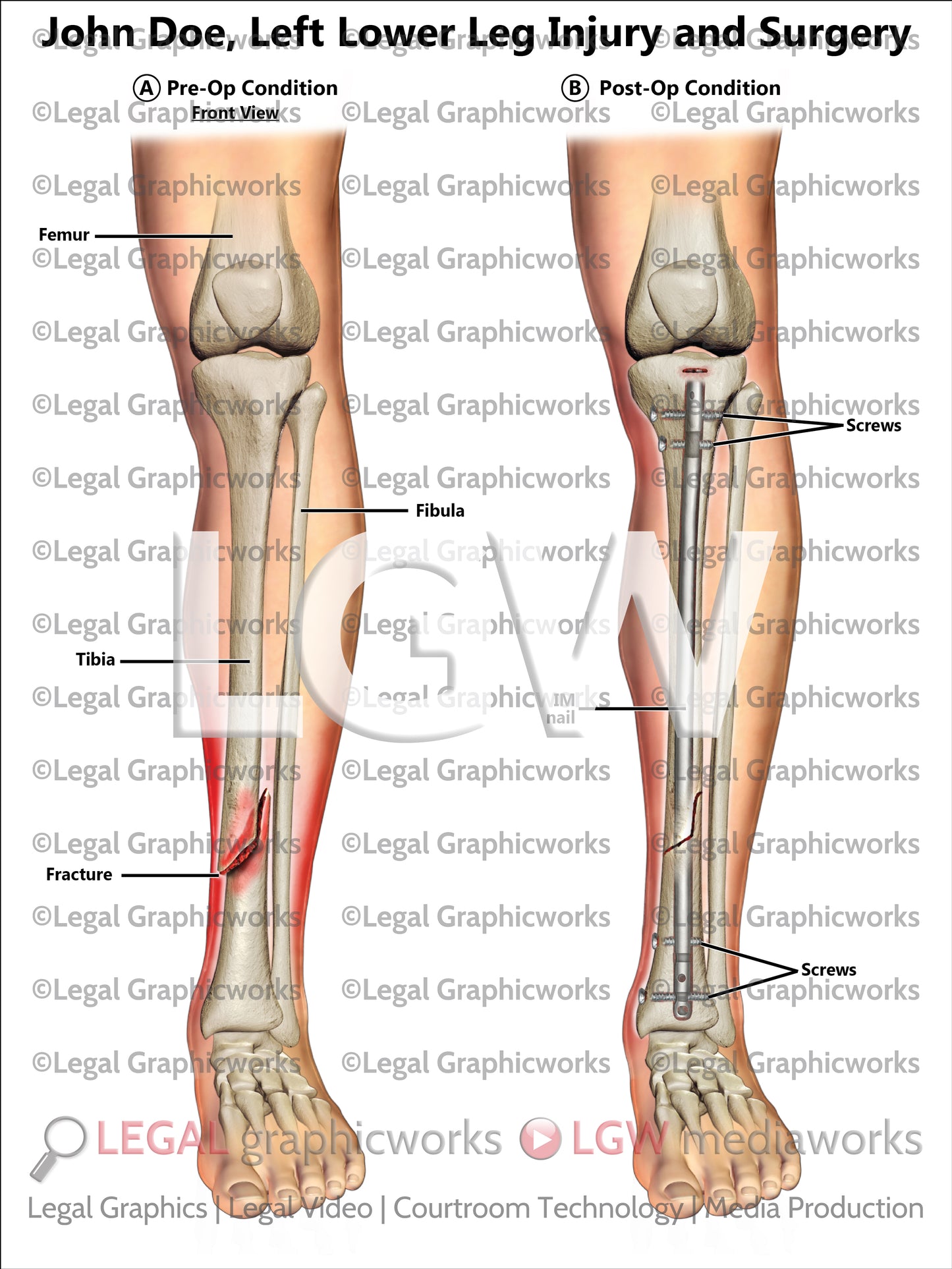 Left Lower Leg Injury and Surgery