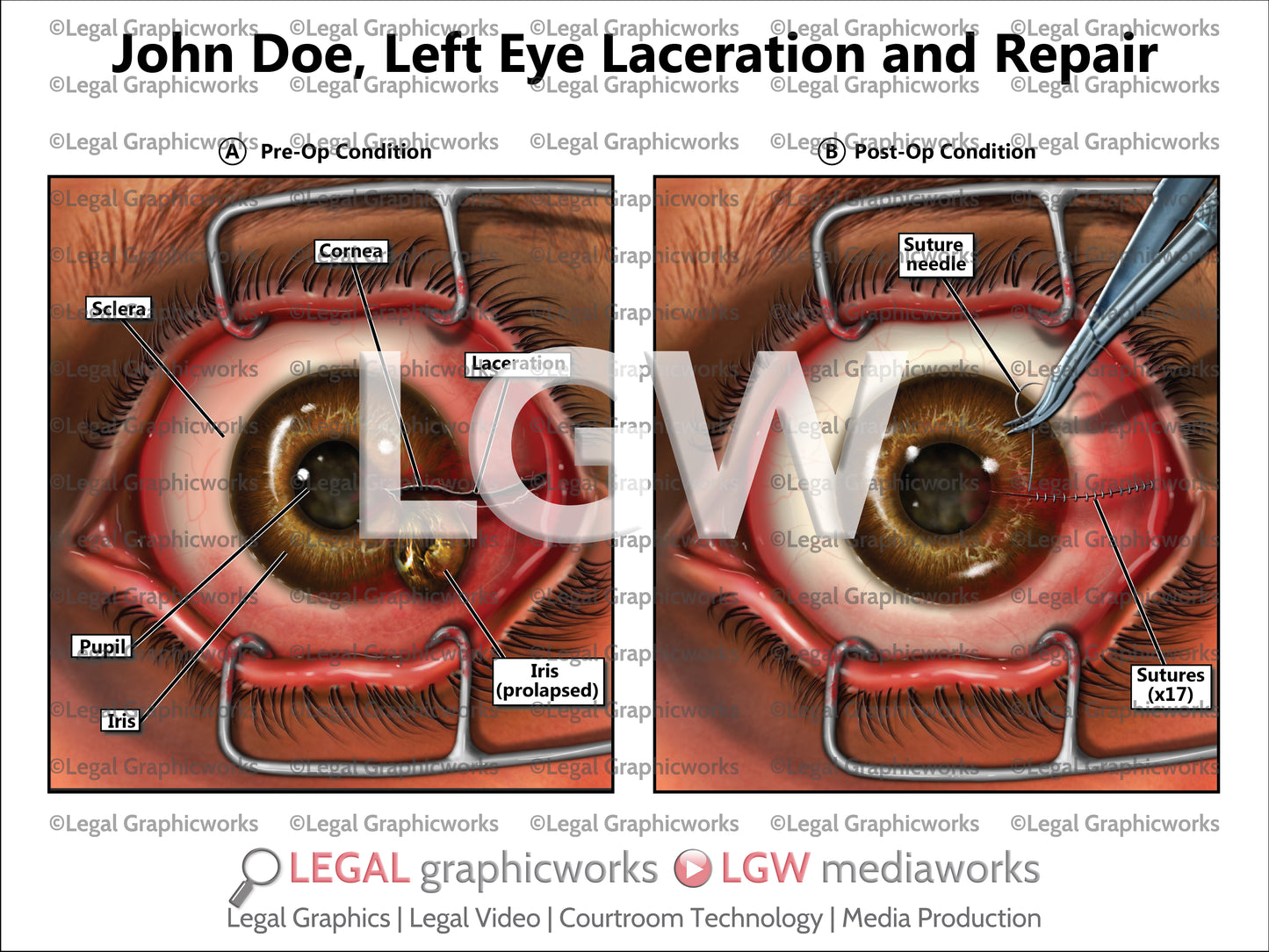 Left Eye Laceration and Repair