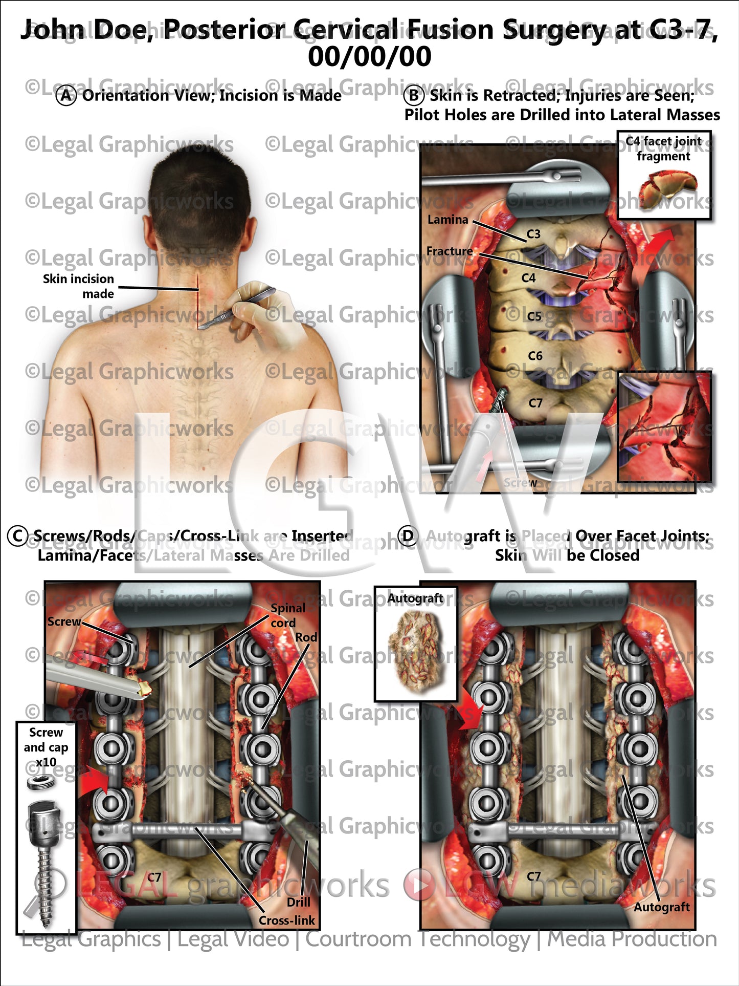 Posterior Cervical Fusion Surgery at C3-7