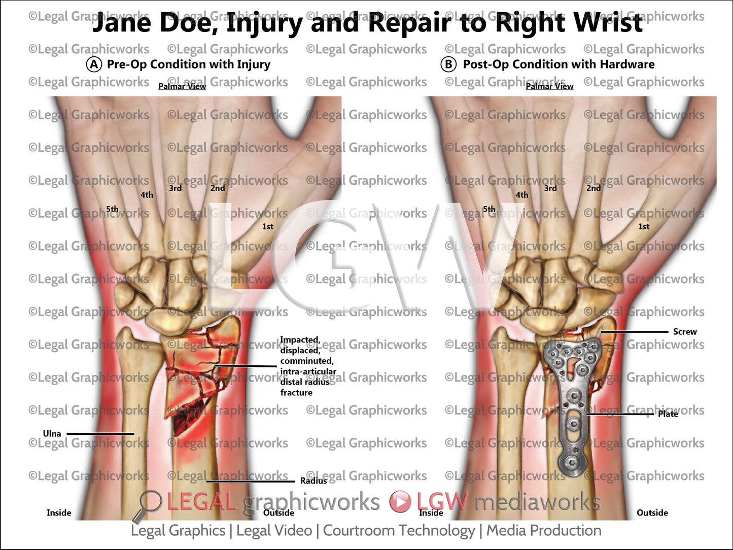 Injury and Repair to Right Wrist