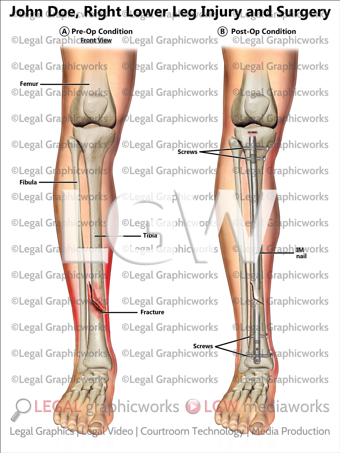 Right Lower Leg Injury and Surgery