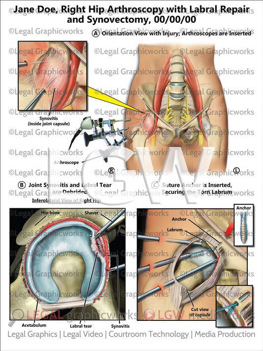 Right Hip Arthroscopy with Labral Repair and Synovectomy