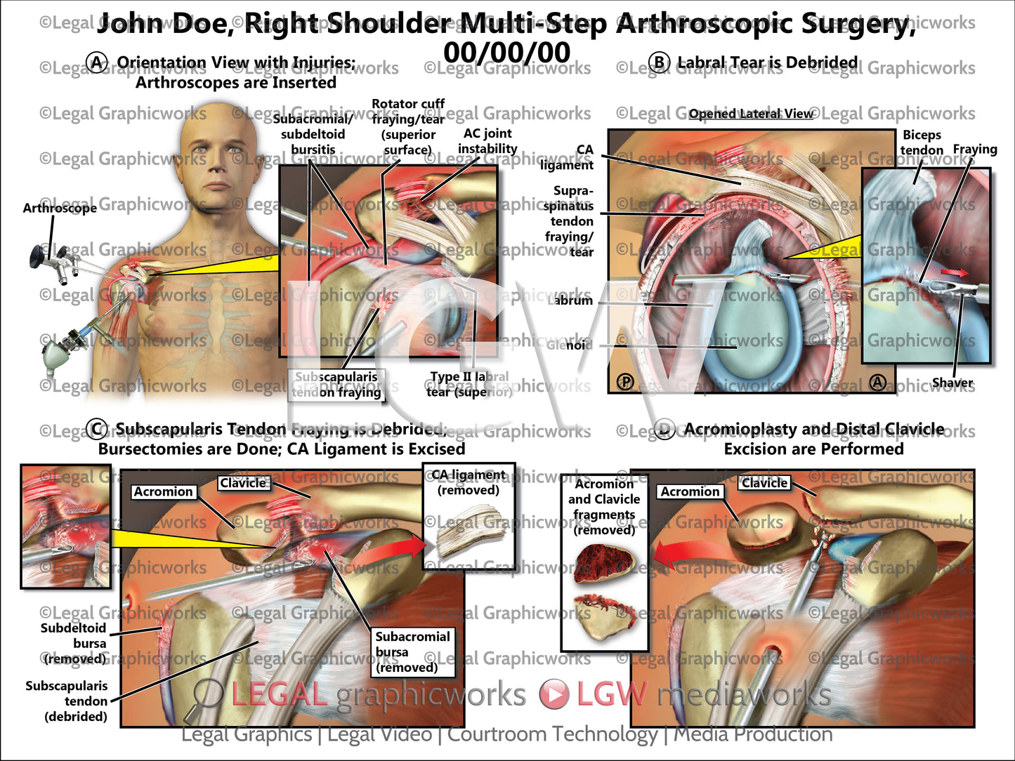 Right Shoulder Multi-Step Arthroscopic Surgery