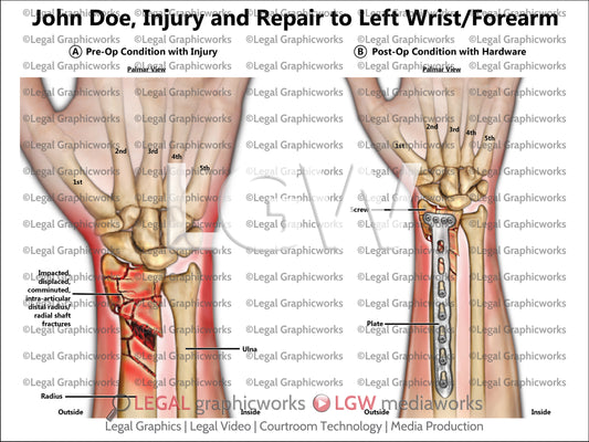 Injury and Repair to Left Wrist/Forearm