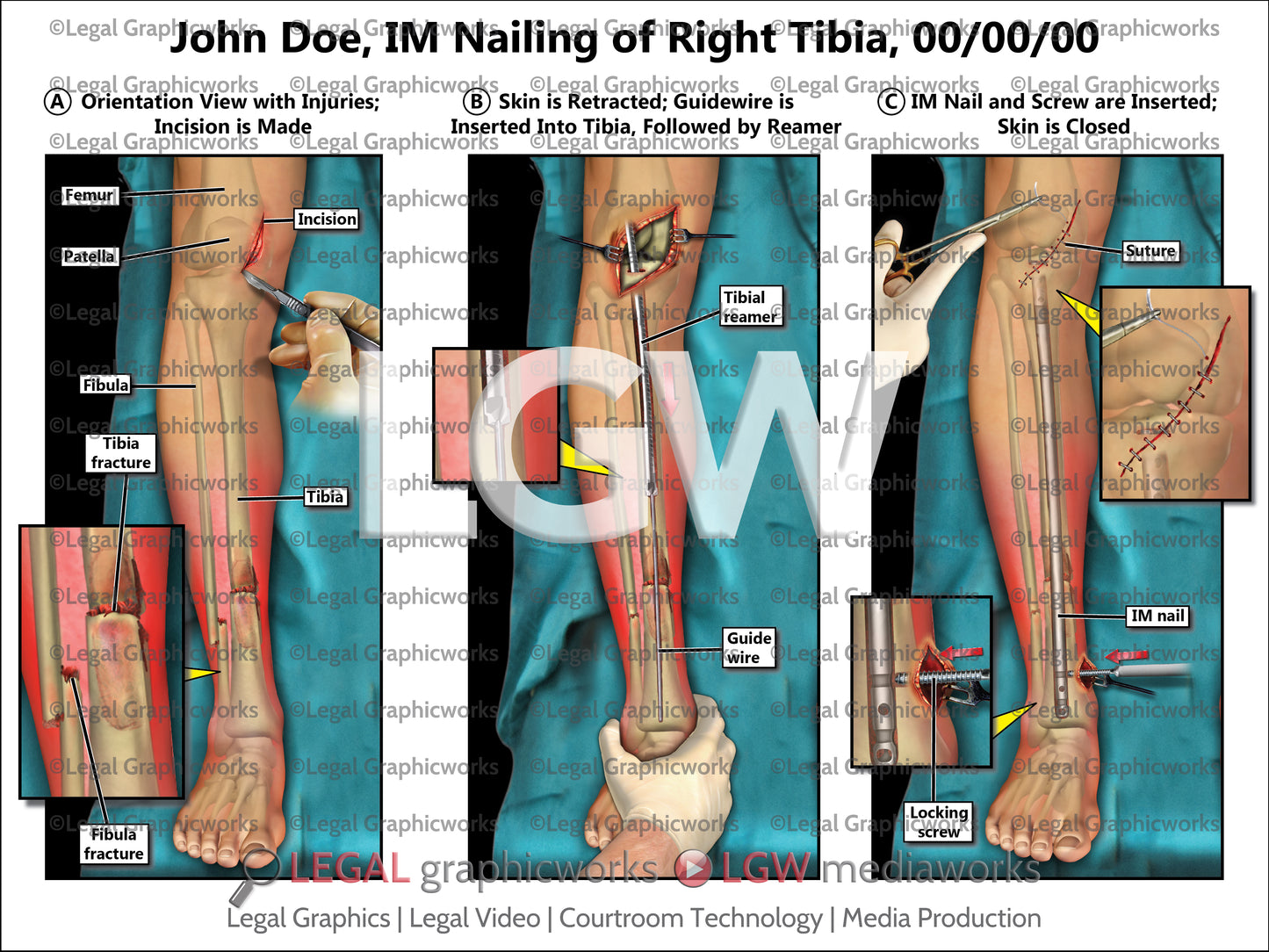 IM Nailing of Right Tibia