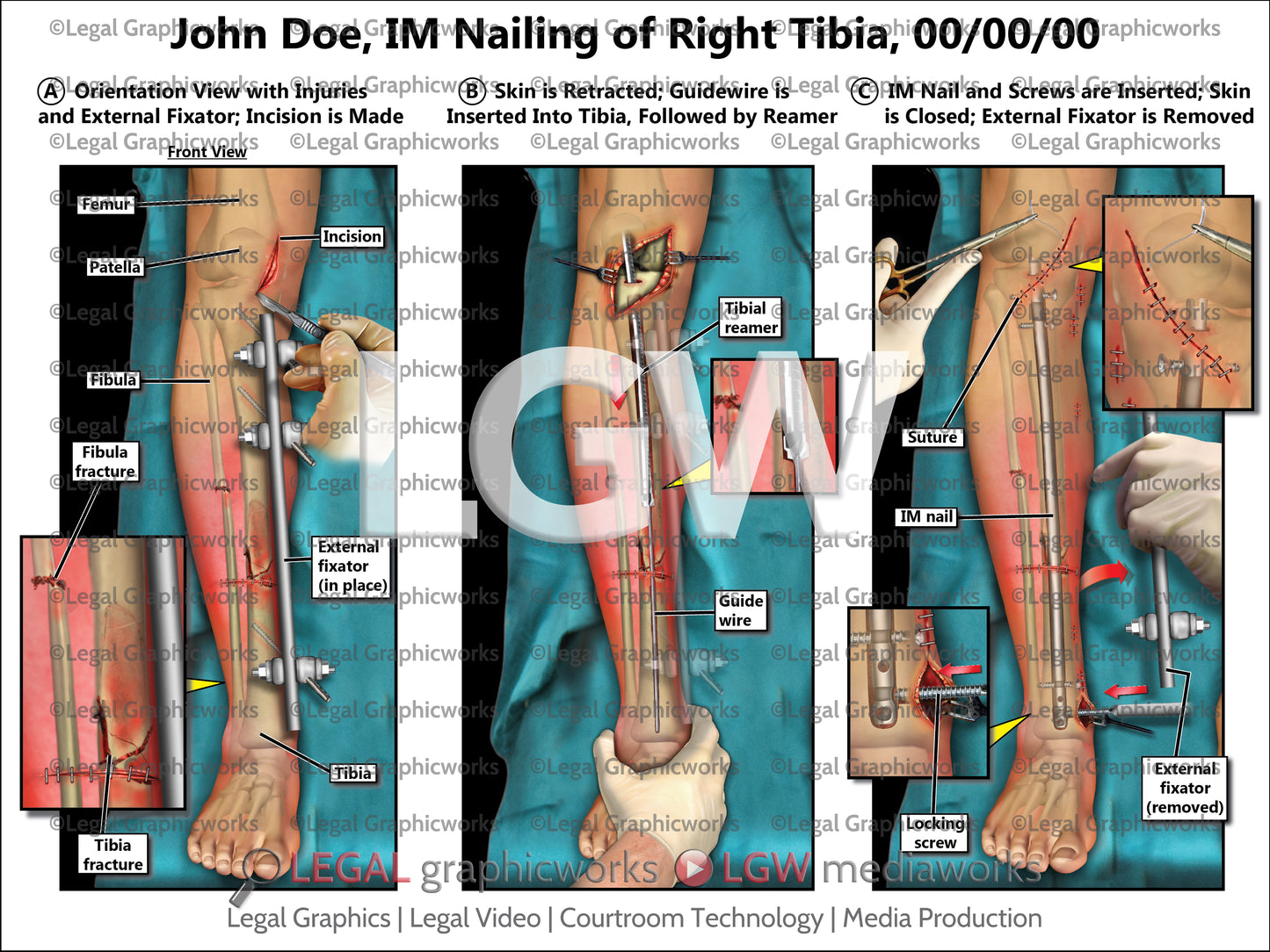 IM Nailing of Right Tibia