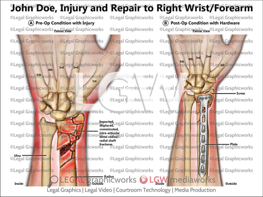 Injury and Repair to Right Wrist/Forearm