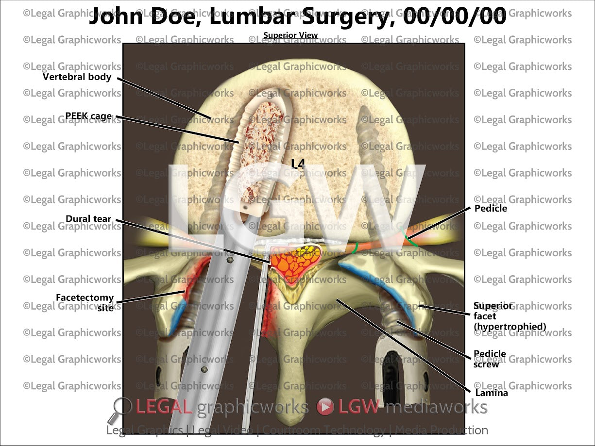 Lumbar Surgery