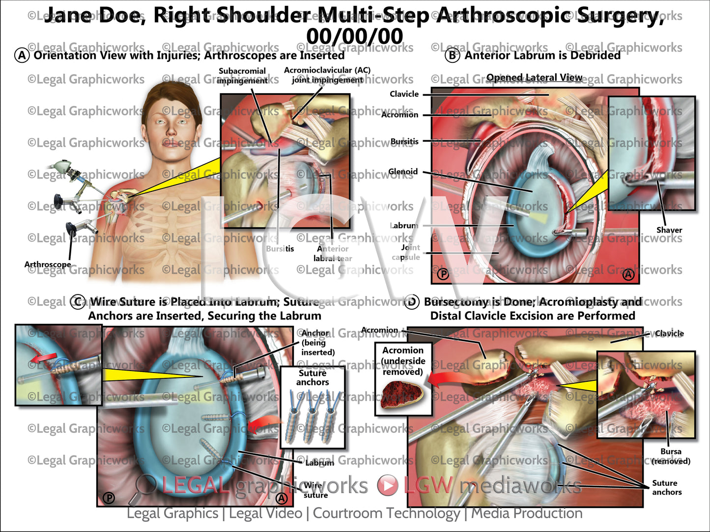 Right Shoulder Multi-Step Arthroscopic Surgery