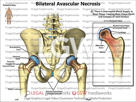 Bilateral Avascular Necrosis