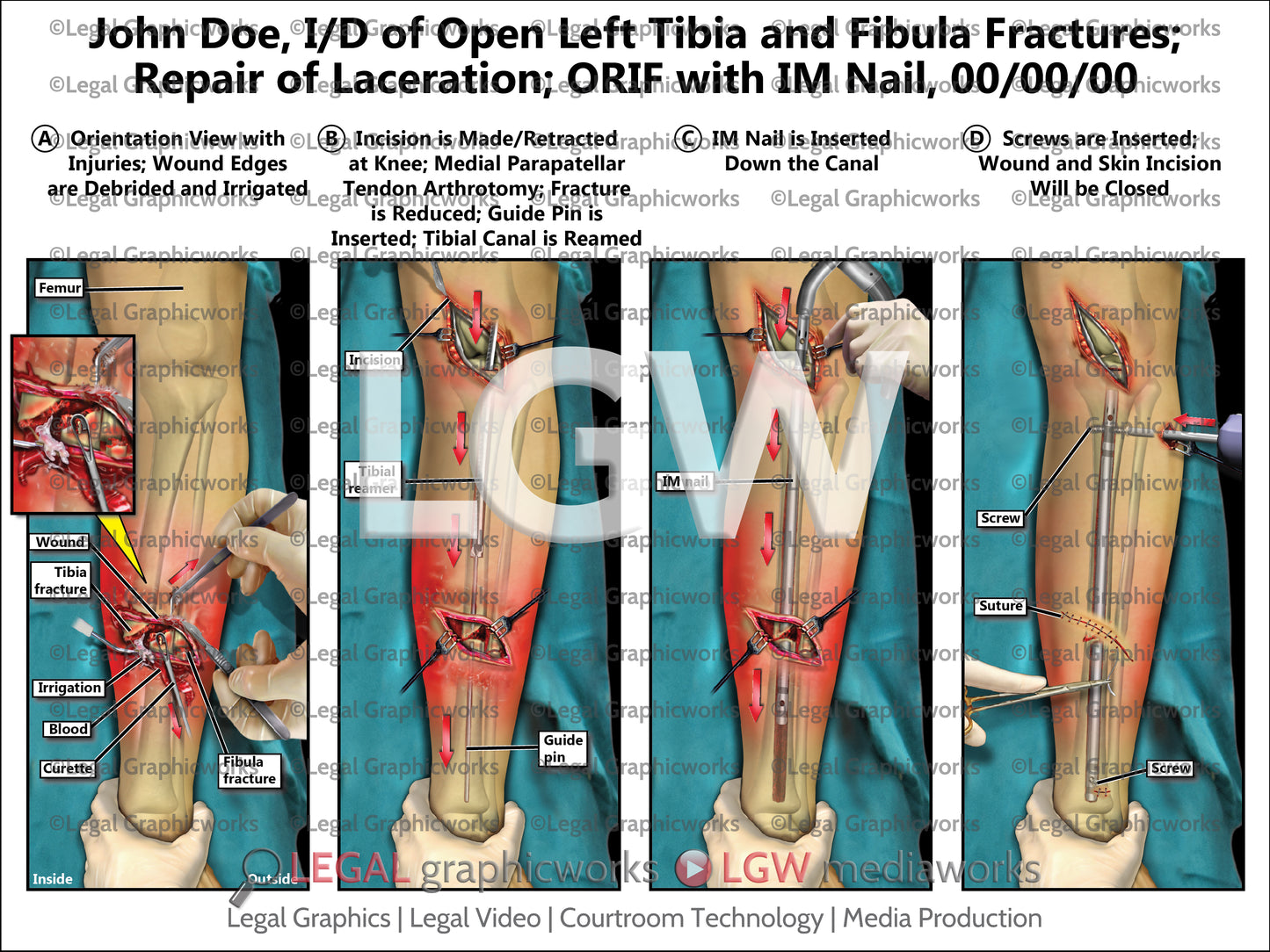 I/D of Open Left Tibia and Fibula Fractures; Repair of Laceration; ORIF with IM Nail