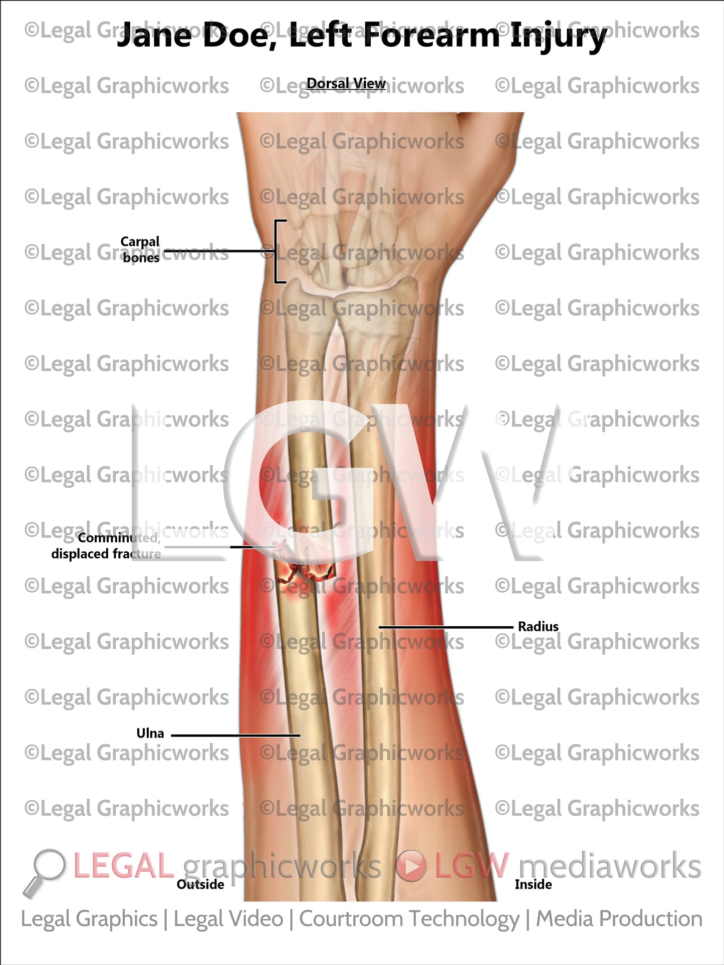 Left Forearm Injury