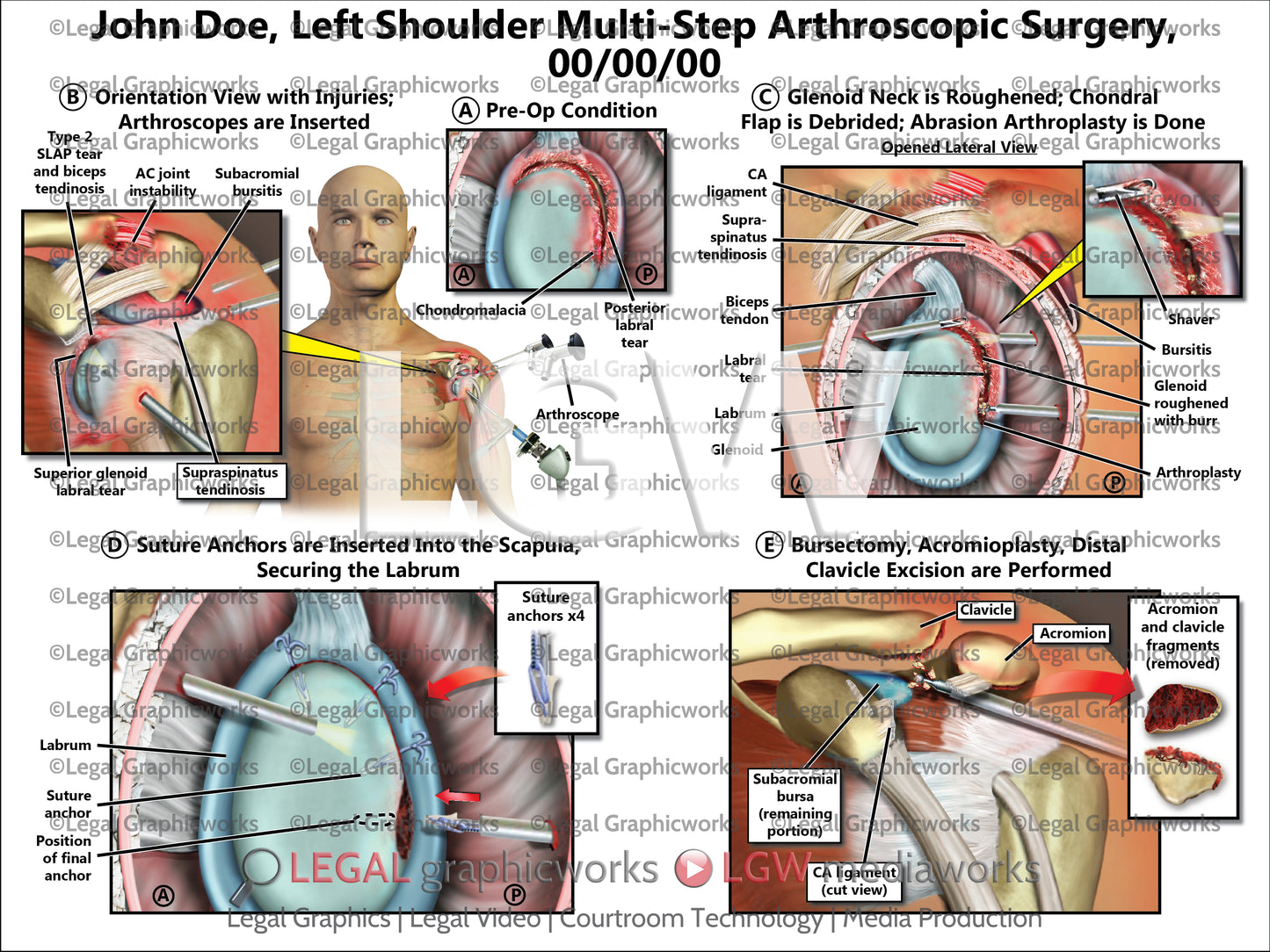 Left Shoulder Multi-Step Arthroscopic Surgery