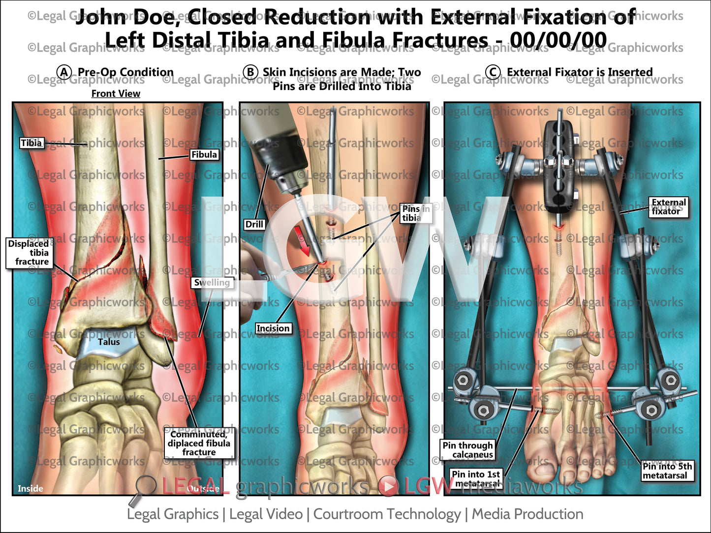 Closed Reduction with External Fixation of Left Distal Tibia and Fibula Fractures