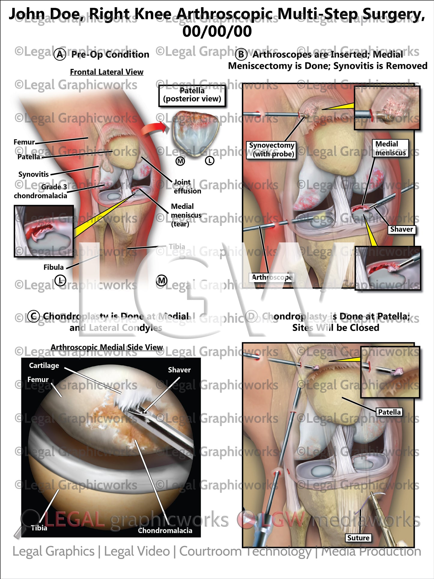 Right Knee Arthroscopic Multi-Step Surgery