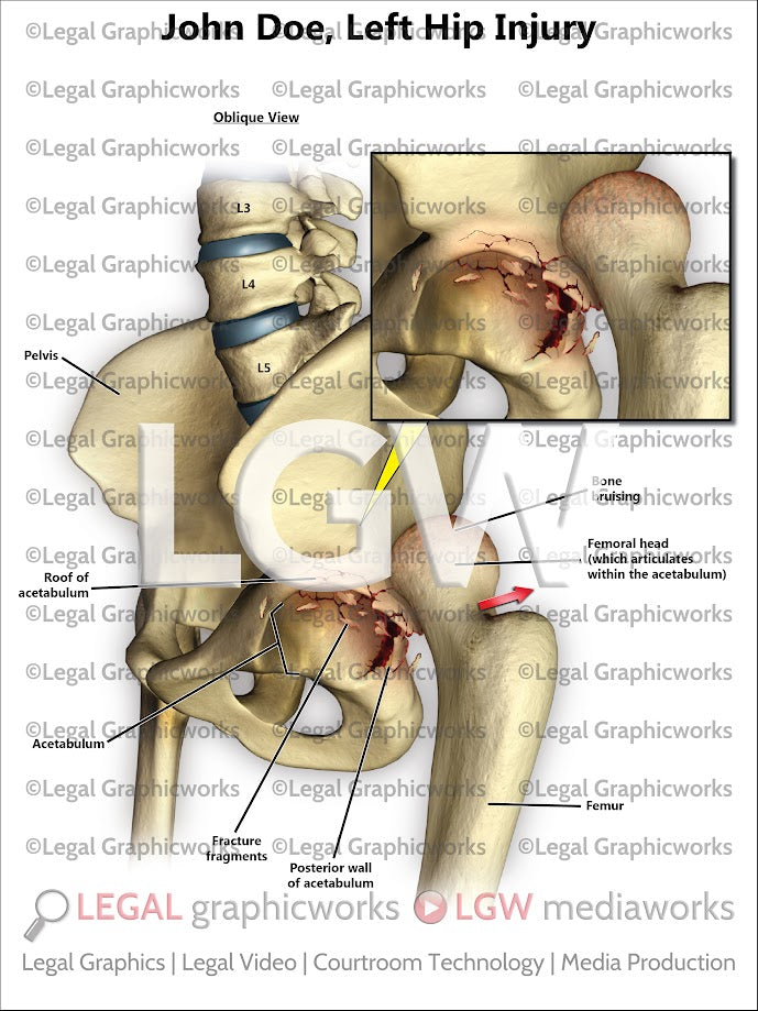 Left Hip Injury