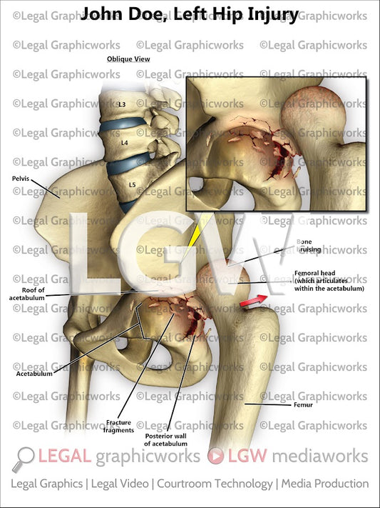 Left Hip Injury