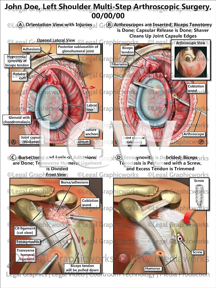 Left Shoulder Multi-Step Arthroscopic Surgery