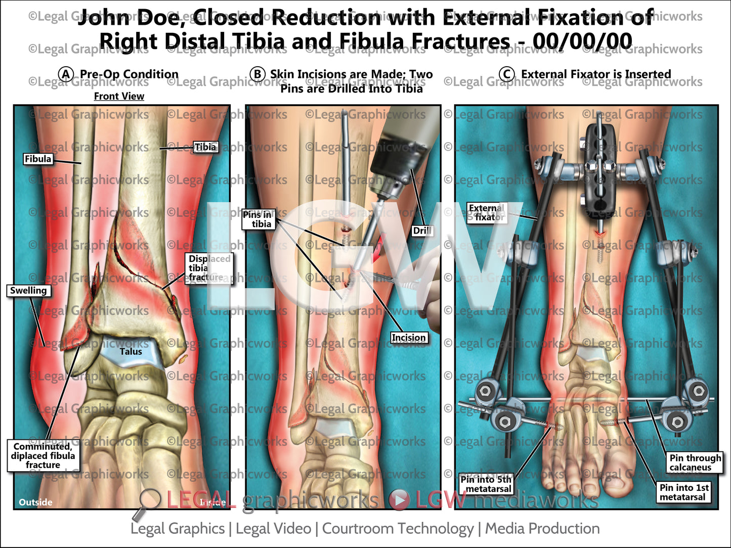 Closed Reduction with External Fixation of Right Distal Tibia and Fibula Fractures