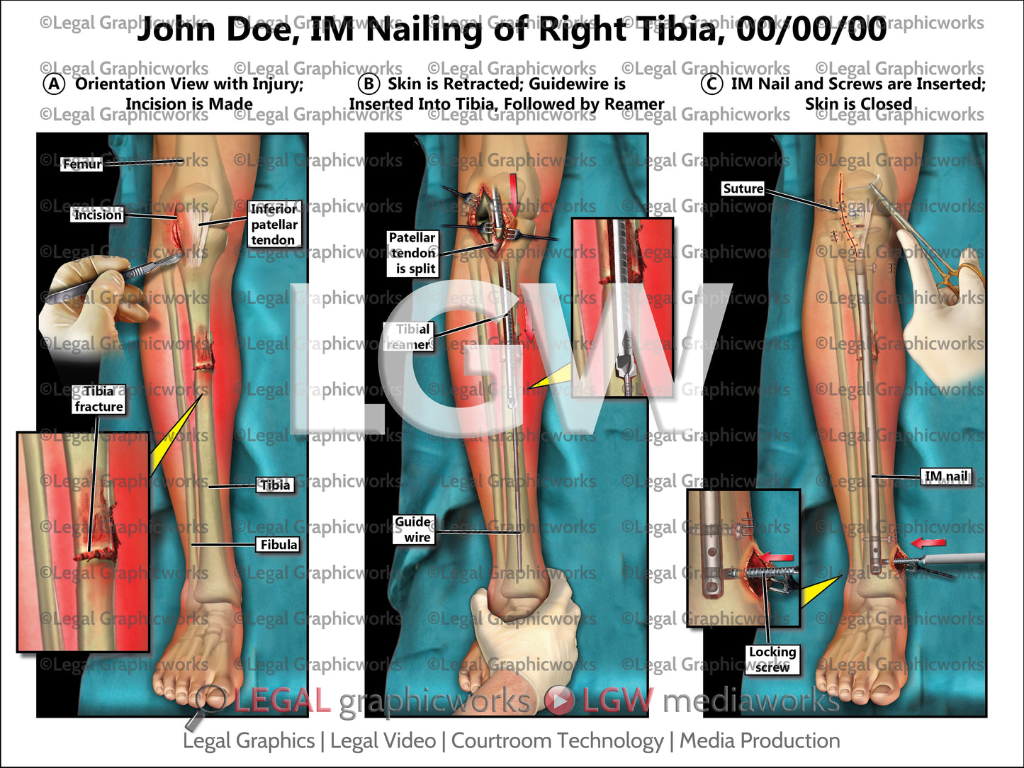 IM Nailing of Right Tibia