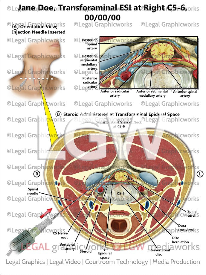 Transforaminal ESI at Right C5-6