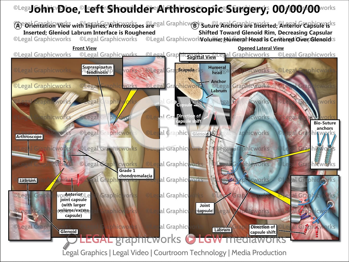 Left Shoulder Arthroscopic Surgery