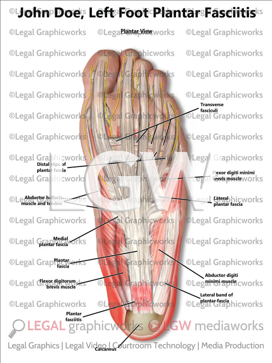 Left Foot Plantar Fasciitis