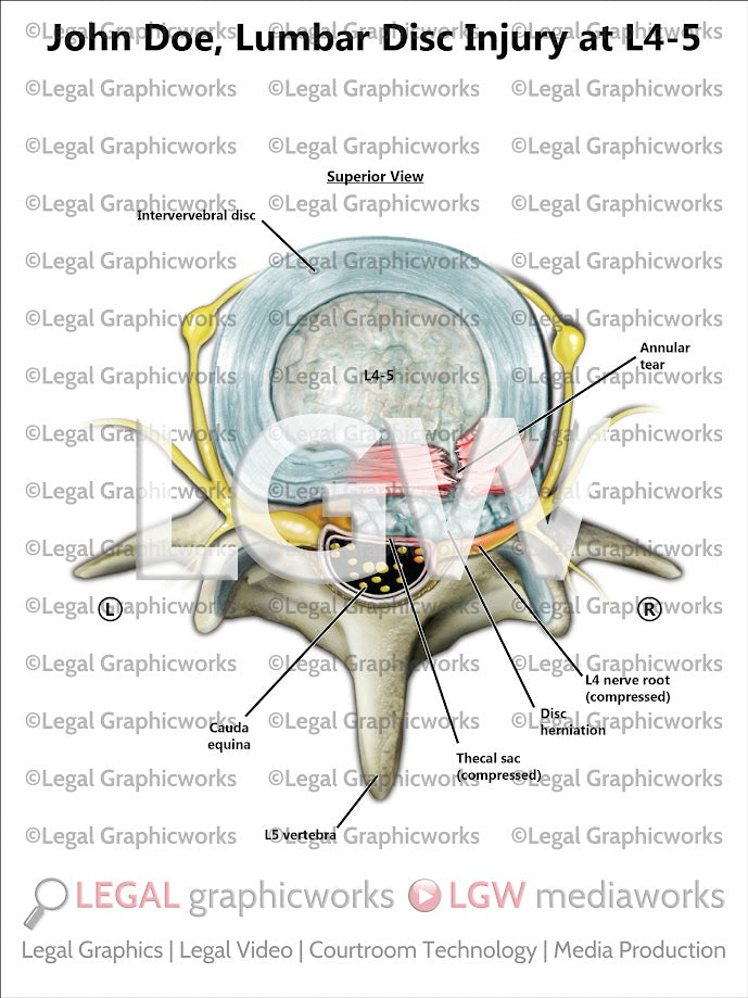 Lumbar Disc Injury at L4-5
