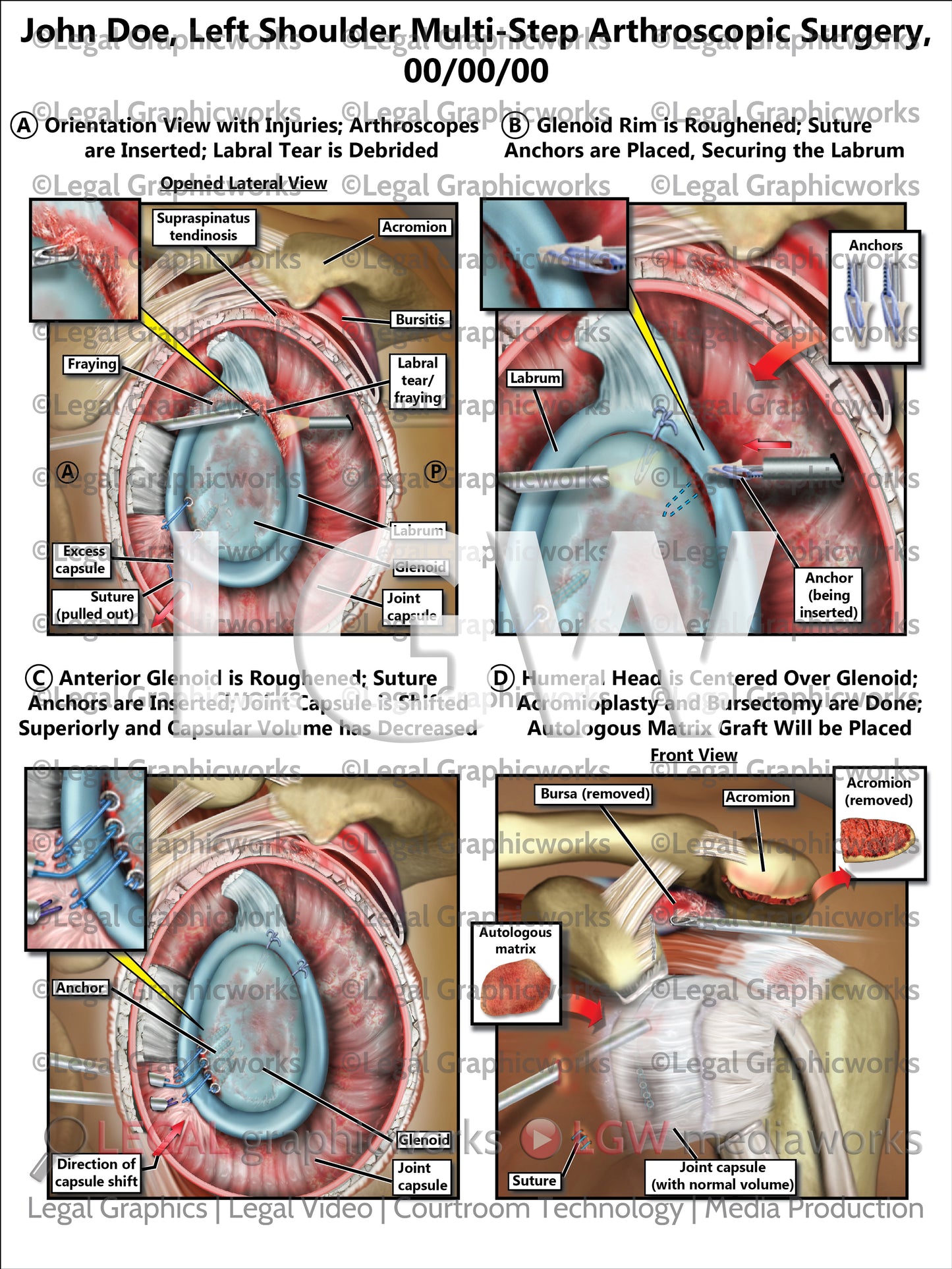 Left Shoulder Multi-Step Arthroscopic Surgery