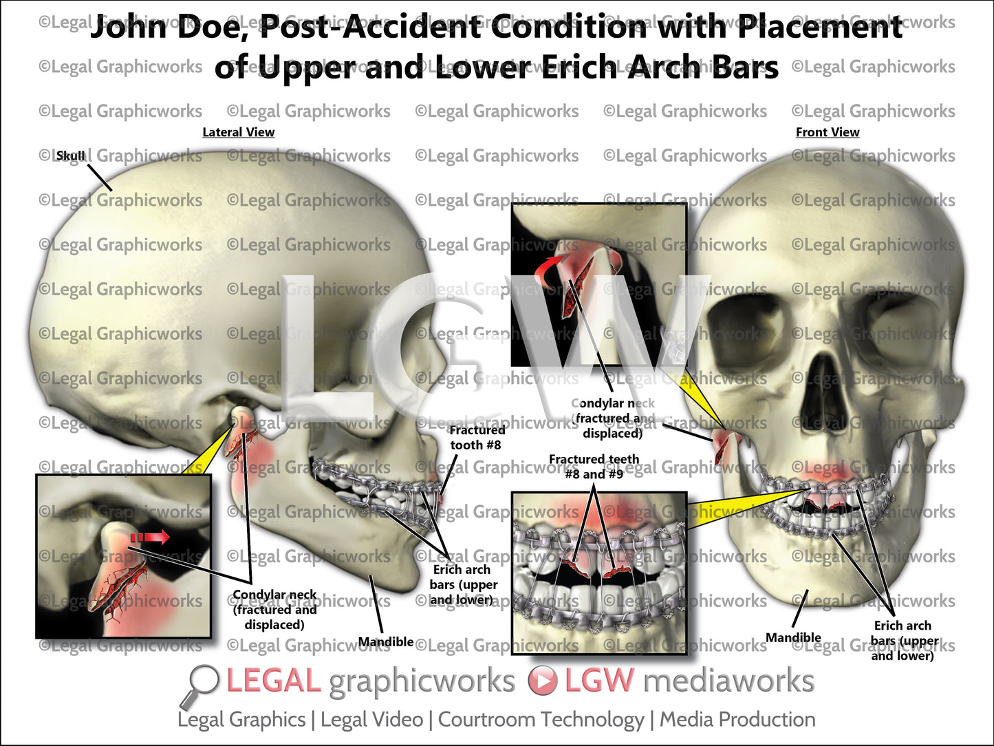Post-Accident Condition with Placement of Upper and Lower Erich Arch Bars