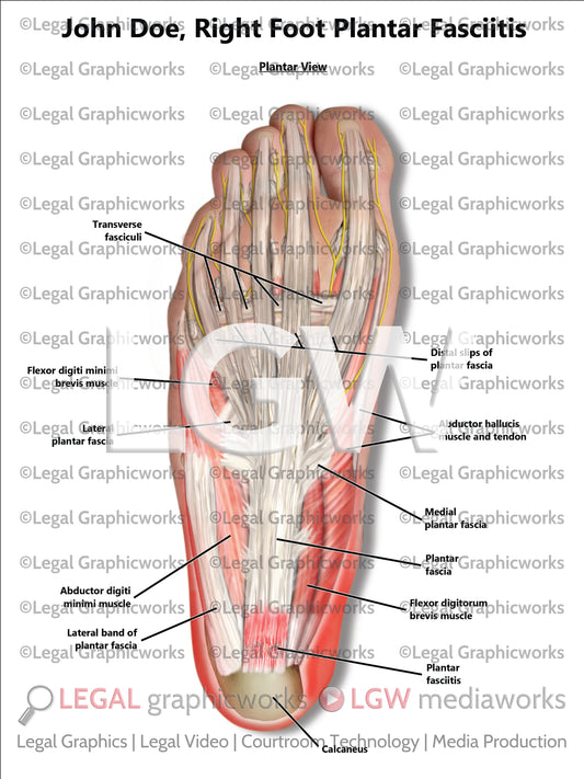 Right Foot Plantar Fasciitis