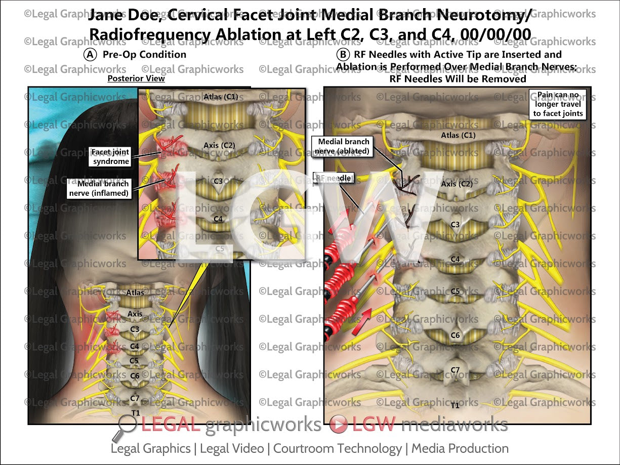 Cervical Facet Joint Medial Branch Neurotomy/Radiofrequency Ablation at Left C2, C3, and C4