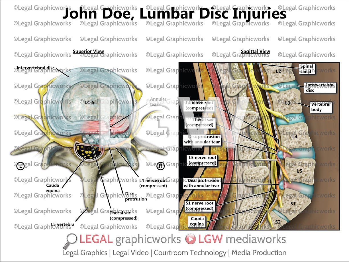 Lumbar Disc Injuries