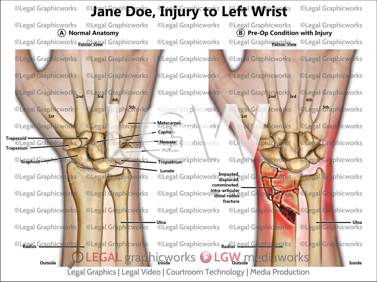 Injury to Left Wrist
