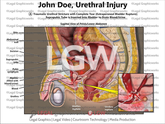Urethral Injury