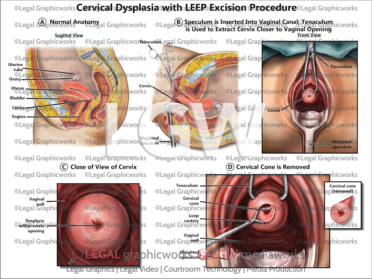 Cervical Dysplasia with LEEP Excision Procedures