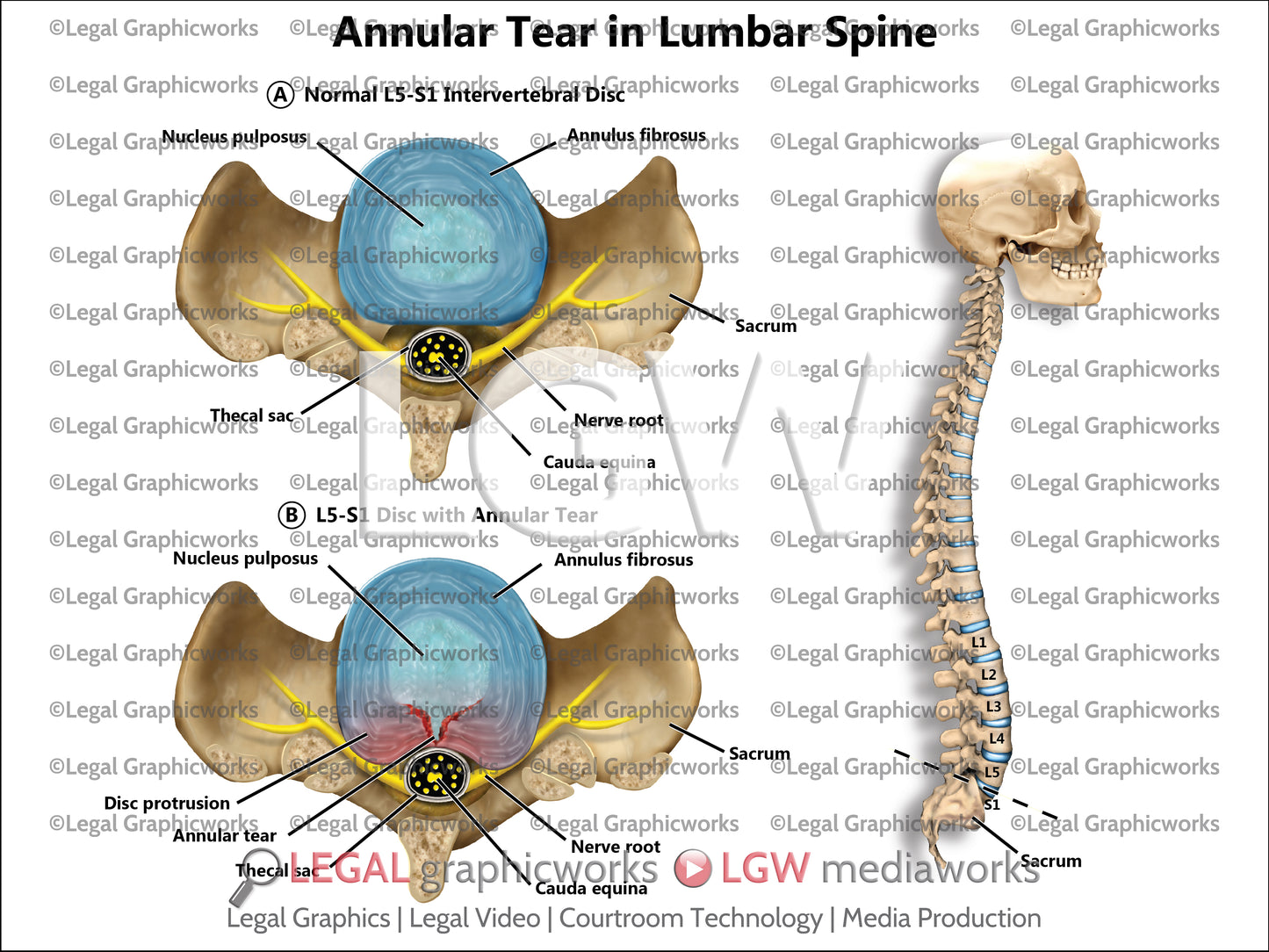 Annular Tear in Lumbar Spine