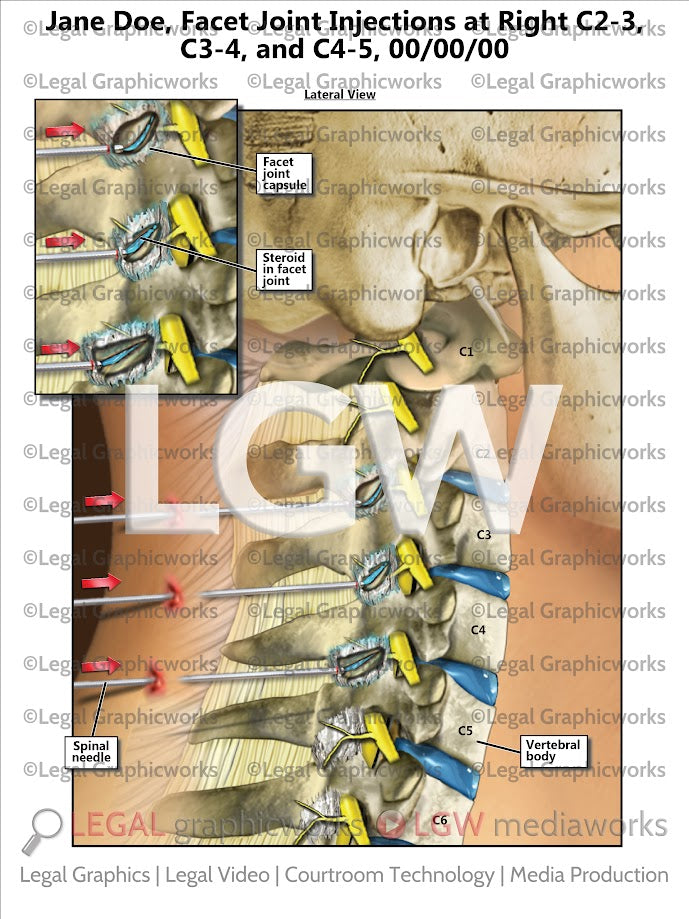 Facet Joint Injections at Right C2-3, C3-4, and C4-5