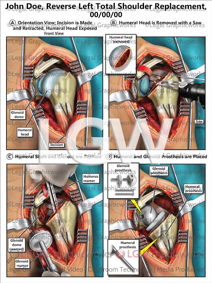 Reverse Left Shoulder Replacement