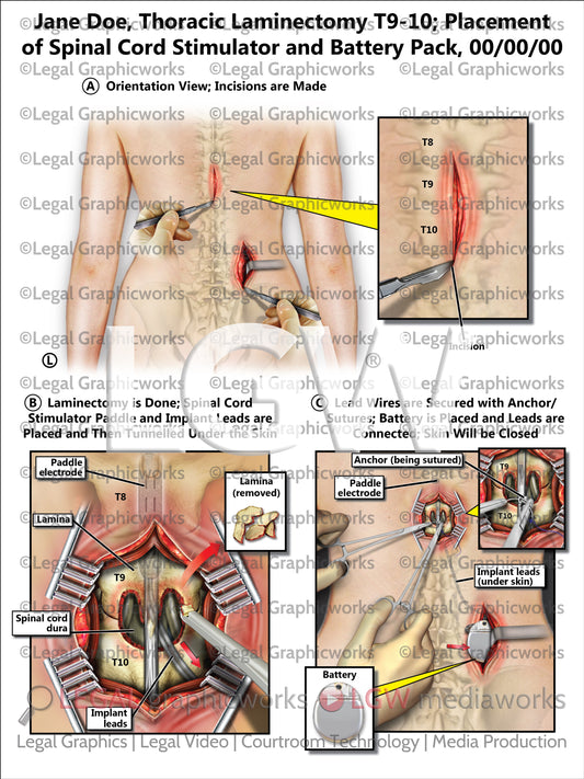 Thoracic Laminectomy T9-10; Placement of Spinal Cord Stimulator and Battery Pack