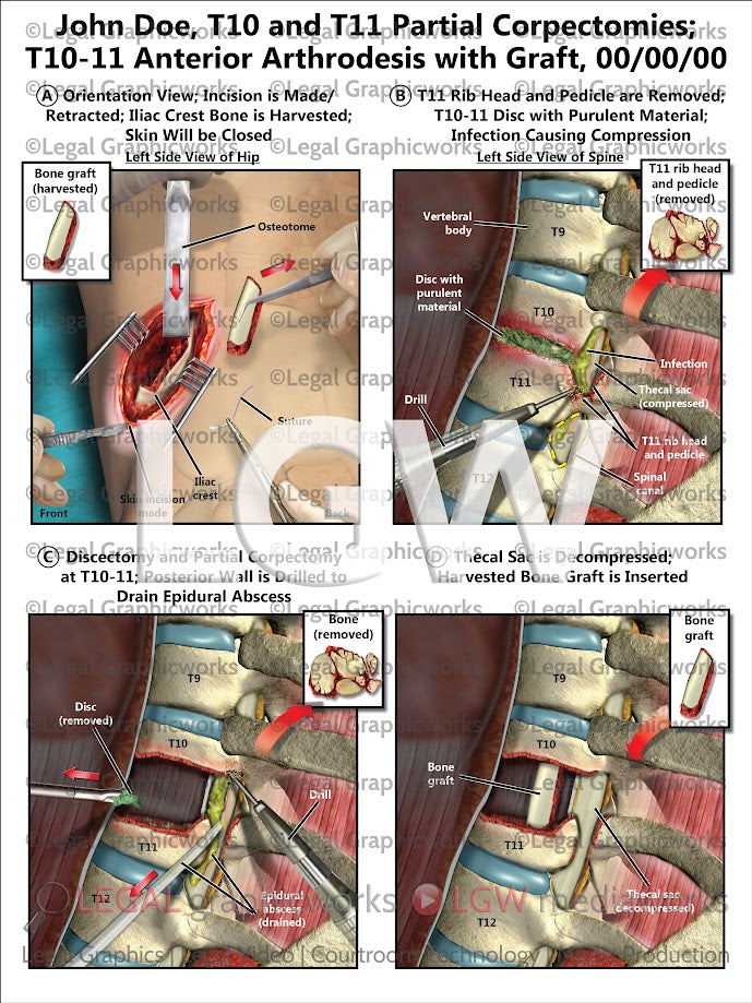 T10 and T11 Partial Corpectomies; T10-11 Anterior Arthrodesis with Graft