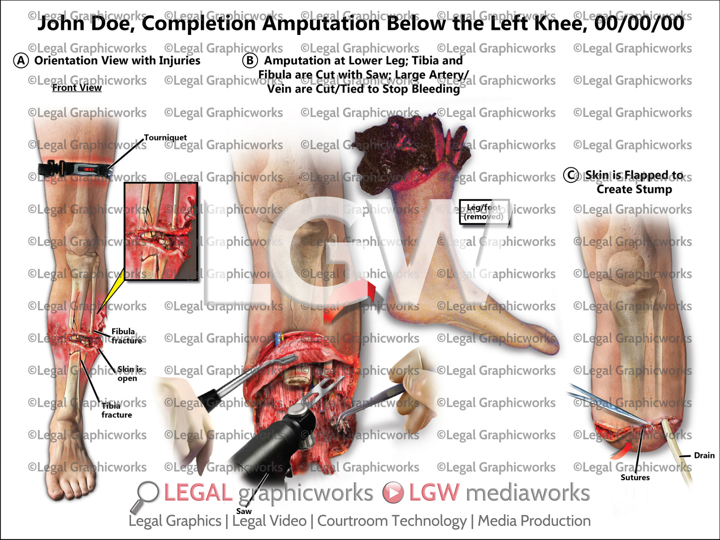 Completion Amputation Below the Left Knee