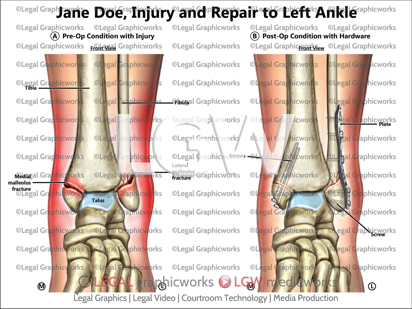 Injury and Repair to Left Ankle