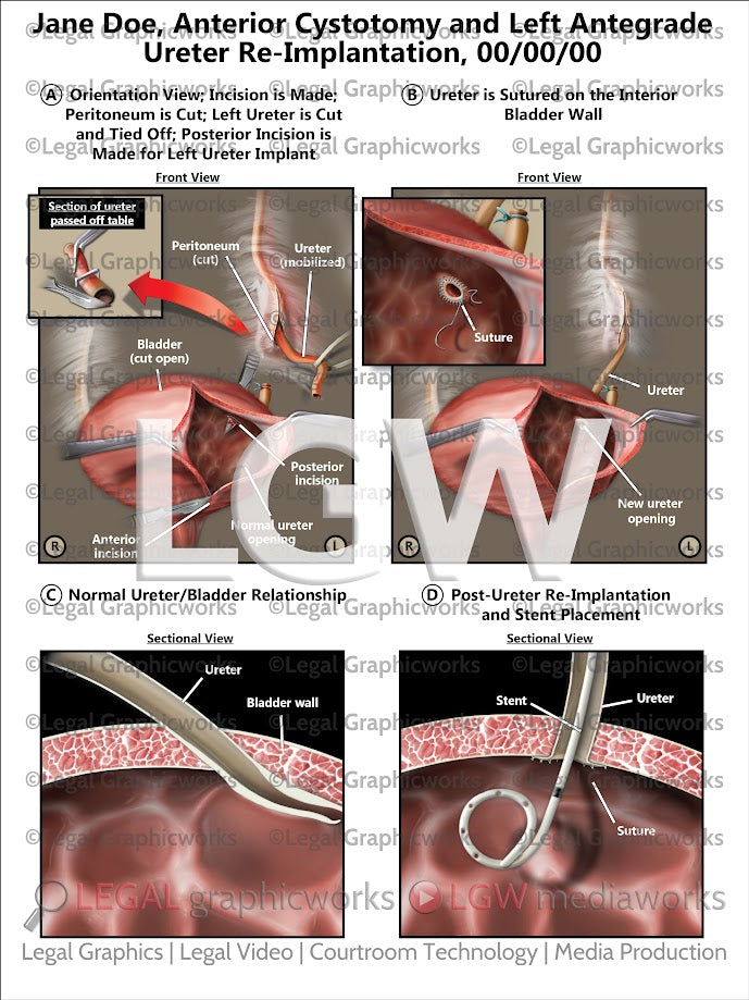 Anterior Cystotomy and Left Antegrade Ureter Re-Implantation